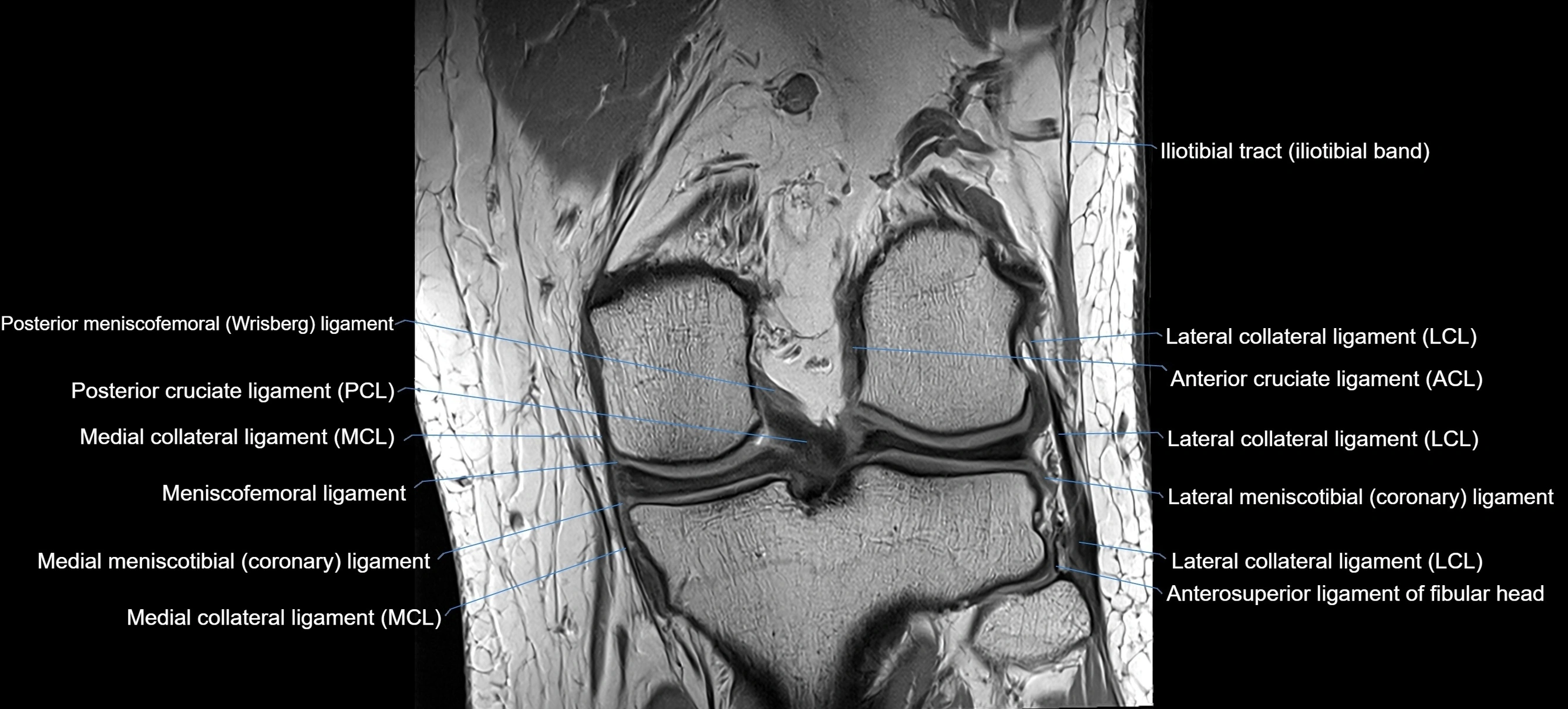 MRI coronal  ligaments cross sectional anatomy 3T  radiology  image-img-04001-00025.webp